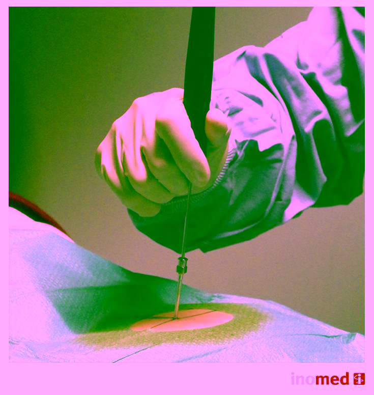 Ein Facharzt führt die Kryodenervation am Rücken durch