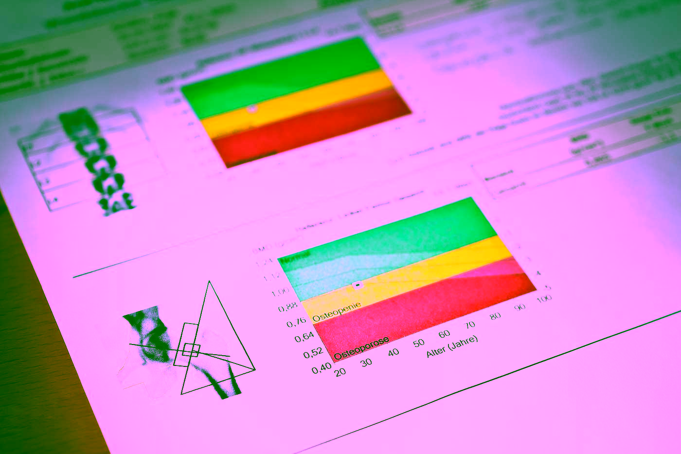 Ergebnisse der DXA Knochendichtemessung mit schematischer Darstellung der Knochen und Graphen