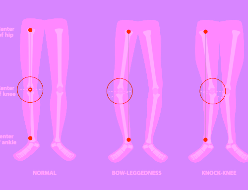 Kniegelenkersatz: Das gerade Bein ist nicht mehr das Standardziel