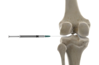 3D-gerenderte Darstellung einer Spritzeninjektion ins Knie